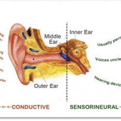Learn about the different types of hearing loss